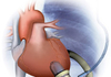 В Италии проведена первая в мире пересадка постоянного искуственного сердца 15-л