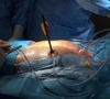 Хирурги из Турина спасли мужчину со стрелой в сердце